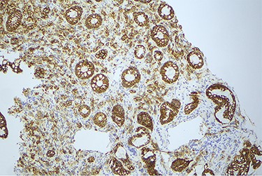 Histology slide showing positive immunohistochemical staining for E-cadherin.