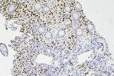 Histology slide showing positive immunohistochemical staining of estrogen receptor.
