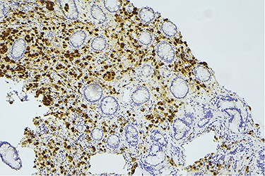 Histology slide showing positive immunohistochemical staining for GATA receptor.