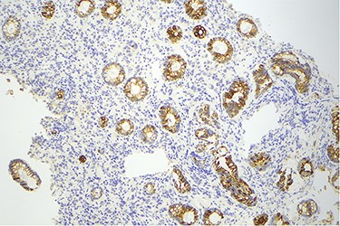 Histology slide showing CK20 staining of colon epithelium, however, there is no uptake in the tumor cells.