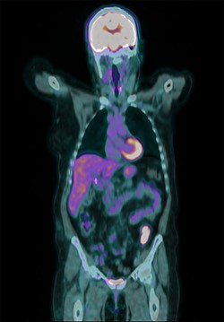 PET scan showed only the retroperitoneal mass involving the proximal sigmoid colon with no other evidence of metastatic disease.