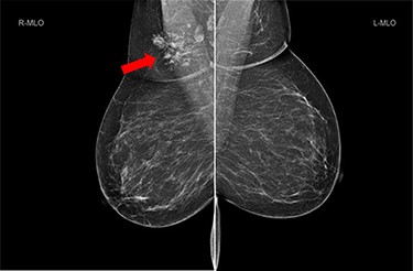 Bilateral mammogram shows mixed density glandular breast tissue with no focal abnormality within the breast. The right accessory breast tissue had increased in size and density (red arrow) from her previous mammogram with distortion and indeterminate imaging appearance, M3 (Royal College of Radiologist, Breast Group Classification).
