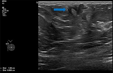 Ultrasound scan of right axillary accessory breast tissue shows focal area of illdefined hypoechogenicity underlying the dermis measuring 10.9 × 8.3 mm (blue arrow). No associated significant hypervascularity. The imaging appearance are indeterminate, U3 (Royal College of Radiologist, Breast Group Classification).