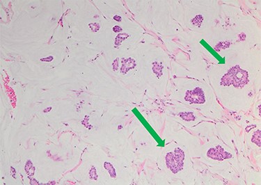 Nests of tumour cells with intermediate-grade nuclei are seen within pools of extra-cellular mucin 10× haematoxylin and eosin stain (green arrow).