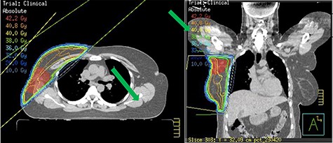Radiotherapy plans showing boost to tumour bed.