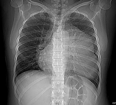 Chest x-ray showing a radiopaque image at the left side of the cardiac silhouette from the second to seventh costal arc and deviation of the airway to the right side without pleural effusion.