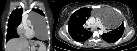 (A) Coronal venous phase tomography showing a heterogeneous extrapulmonary multiloculated and predominantly fluid density tumor located in the left side lateral to the mediastinum with wall enhancement of the borders and no pericardium involvement. (B) Axial delayed phase tomography showing invasion of the tumor to the right thorax.