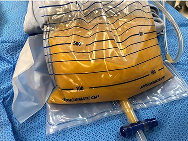 Yellowish and dense fluid obtained from the tumor by US-guided puncture.