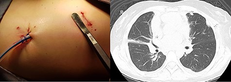 (A) Immediate postoperative view. (B) Postoperative CT scan showing absence of the tumor and a right lobar atelectasis.