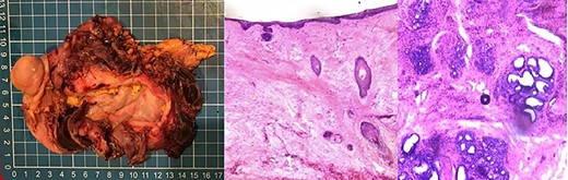 (A) Gross resection specimen. The tumor was predominantly cystic, with a smooth internal lining. Its content was yellowish and pasty, with some hair. The solid component was light brown and rubbery consistency. (B) H & E at 40×. The wall was formed by epidermis and dermis with some hair follicles. (C) H & E 40×. Within the solid component, there were mucosecretory glands with columnar epithelium, serous acini and ducts lined by columnar epithelium. No signs of atypia were observed.