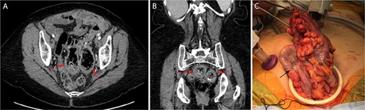Cross-sectional CT imaging readily identified the two large GCD (red arrows) on both axial (A) and coronal (B) view. View of the largest GCD (black arrow) during specimen extraction intra-operatively (C).