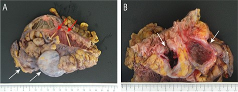 The resected segment of sigmoid colon and proximal rectum demonstrates the two known GCD (white arrows) with notable absence of external exudate and their luminal ostia (red arrows) marked by toothpicks (A). Open cross-section of the specimen demonstrates markedly narrow diverticular ostia (white arrows) with smaller adjacent (left) diverticular openings (B). The diverticulum on the right shows granular, polypoid mucosa with focal ulceration, while the GCD on the left has extensive ulceration and a thickened, fibrotic wall without perforation.