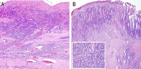 Photomicrographs of one GCD showing extensive ulceration (A) with underlying fibrosis (B) and marked submucosal plasma cell infiltration (inset, H and E, original magnification ×40; inset original magnification ×400). There is a small portion of non-ulcerated mucosa at far right for reference (B).