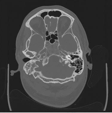 Axial CT image slice showing opacification of the right middle ear cavity and mastoid air cells.