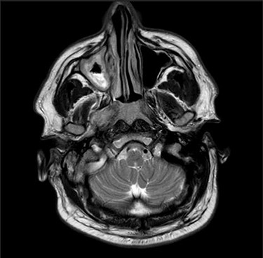 Axial MRI image showing high attenuation lesion affecting the right skull base.