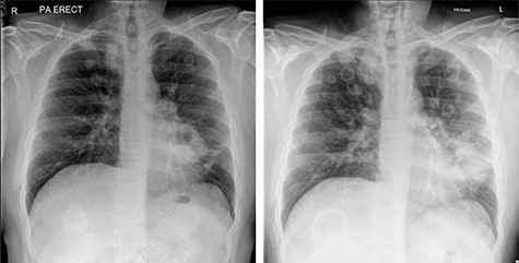 Chest radiographs showing progression of cavitating pulmonary lesions.