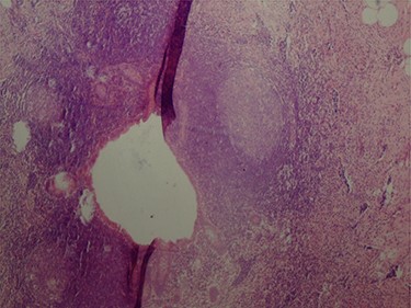 Constricted appendicular lumen.