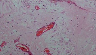 Decidual cells with abundant cytoplasm.