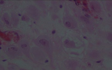 Large decidual cell with abundant eosinophilic cytoplasm and round nuclei with prominent nucleoli.