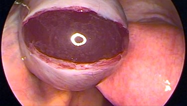 Laparoscopic image showing the ovarian stigma of the ruptured thick tunica albuginea in PCOS patients.