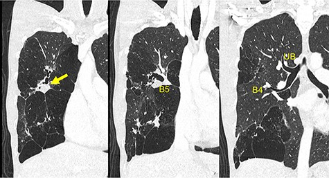 Preoperative chest CT demonstrates a mucinous impaction (Arrow) and blind-end of B5. CT, computed tomography; B, bronchus; UB, upper bronchus.