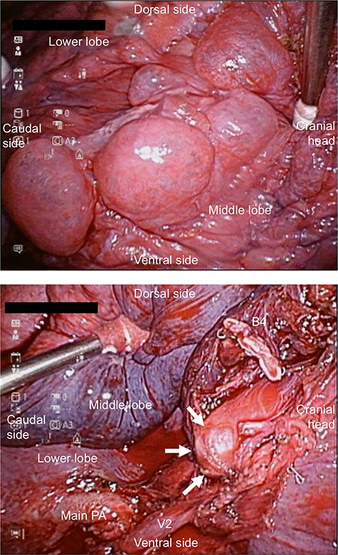 (a) Intraoperative view showing extensive emphysematous changes. (b) Intraoperative view showing the blind-end of B5. B, bronchus; PA, pulmonary artery.