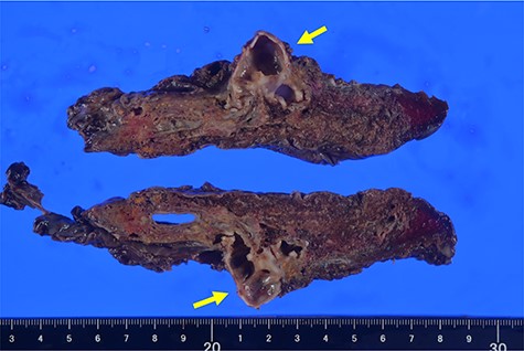 Representative image of macroscopic extracted specimen. Arrow showing blind-end of B5. B, bronchus.