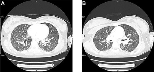 A thoracic CT with contrast conducted 2 days post-injury showed new mild bilateral peri-bronchial wall thickening and bilateral patchy ground-glass changes with early nodular consolidative changes. These features were thought to be in keeping with an infection, either aspirational pneumonia or COVID-19. Pulmonary contusions could have also contributed to the pulmonary changes given the clinical context.