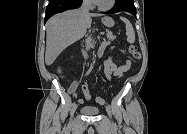 CT scan: dilated appendix with fat stranding, coronal view.