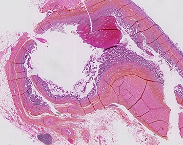 Histology slide: diverticulitis of the appendix.