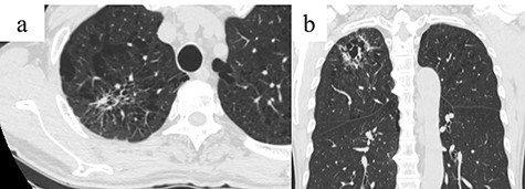 Chest CT showing an infiltrative shadow along the cyst wall with an irregular emphysematous cyst in the right upper lobe (arrow); (a) Axial view and (b) coronal view.