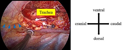 During the first surgery, a tortuous duct was detected in the cranial side of the superior mediastinal dissection area (blue arrowhead).