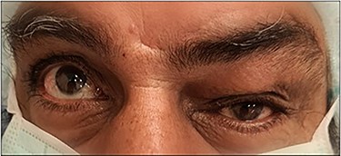 Left eye swelling with inferior globe dystopia.