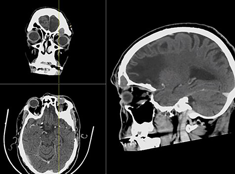 CT with contrast showing a complete left frontal sinus opacification with an inferior bony defect and extension to the left globe and obstruction of the frontal sinus drainage pathway in coronal (a), axial (b) and sagittal (c) views.