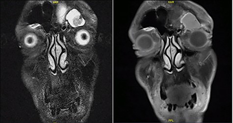 Face MRI showing a mass in the left frontal sinus with hypertense T1 signal and extension to left orbit.