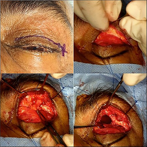 (a, b) Trans-orbital superior lid crease marking of the left eye and dissection until reaching the orbital rim. (c, d) A medial bulging mass was removed leaving a defect at lower aspect of left frontal sinus.