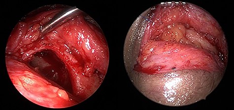 Endoscopic transorbital view of the isolated left frontal sinus cavity after completely peeling off the frontal sinus mucosa (a) and after fat obliteration of the cavity (b).