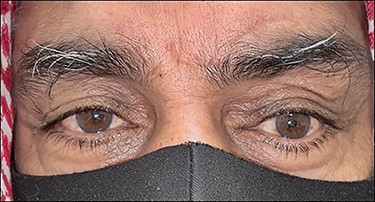 A 3-month-postoperative picture showing improved left globe dystopia and resolved fullness and swelling.