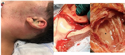 Pre- and intra-operatory images; (A) purulent secretion from the external left canal associated with swelling of retro-auricular area (mastoid) and neck; the skin is red as a sign of inflammation; (B) after retro-auricular incision and press on the neck, the purulent secretion comes out; (C) a curettage of the neck area is necessary to remove the residual secretion (black asterisk) which has not been expelled through the retro-auricular incision.