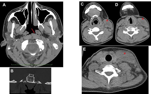 (A) axial view; the red arrow shows edematous torus tubarius; compared to contralateral, the adenoid is hypertrophic but median; the presence of both these conditions contributes to ostium obstruction of the left tuba (B); (C–E) from top to down, the red asterisk shows the imbibition of sternocleidomastoid muscle sign of BA.