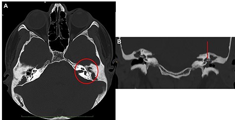 Ear CT scan; (A) axial view; the red circle shows the middle ear filled with inflammatory tissue, with erosion of the ossicular chain; (B) coronal view (the red arrow shows the erosion of malleus and incus); the malleus is not lateralized.