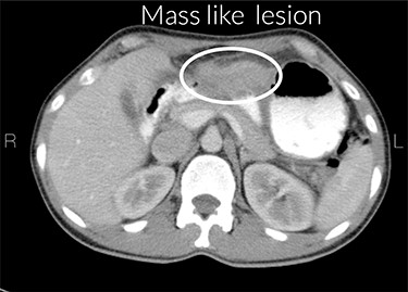 Mass-like lesion in antrum.