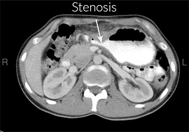 Stenosis of the gastric outlet. R means right and L means left.