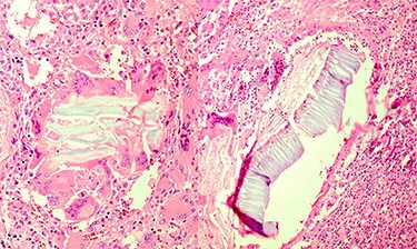 Multinucleated foreign body-type giant cells and inflammatory cells surrounding the vegetable fibers.