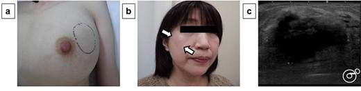 Physical examination and ultrasonography findings: During physical examination, an elastic hard mass measuring ~6 cm in size was palpated in the upper-outer area of the left breast (a). An induration of ~4 cm was also found on the right cheek (b). Mammary ultrasonography revealed an irregular hypoechoic tumor of measuring 45.0 × 43.0 × 32.0 mm in size in the upper-outer quadrant of the left breast (c).