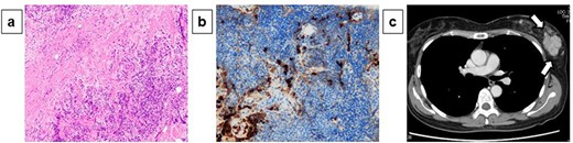 Pathological diagnosis of core-needle biopsy specimens and computed tomography findings: Core-needle biopsy performed in the same site revealed a high degree of mixed T and B lymphocytic and plasma cell infiltration, as well as interstitial fibrosis (×200) (a). Many plasma cells were IgG positive, of which >40% were IgG4 positive (×200) (b). Computed tomography exhibited no significant findings besides the left mammary mass and left axillary swelling (c).