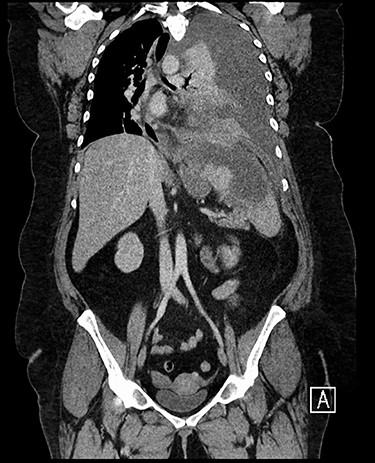 CT chest, abdomen and pelvis coronal view: left-sided empyema and splenic abscess.