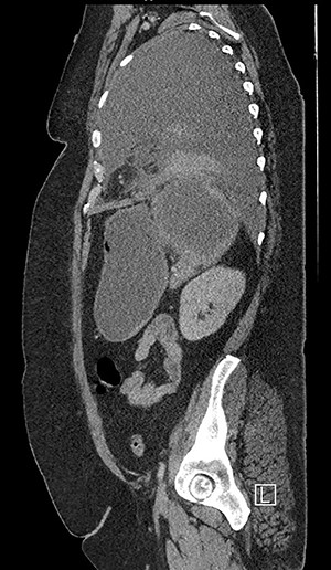 CT chest, abdomen and pelvis sagittal view: left-sided empyema and splenic abscess.