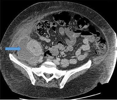 Large right retroperitoneal loculated fluid collection superior to the right pelvic kidney with no internal gaseous contents.