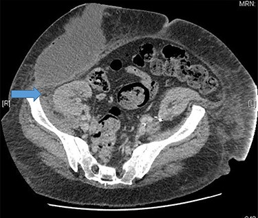 Tiny gas pockets noted close to the anterior margin.